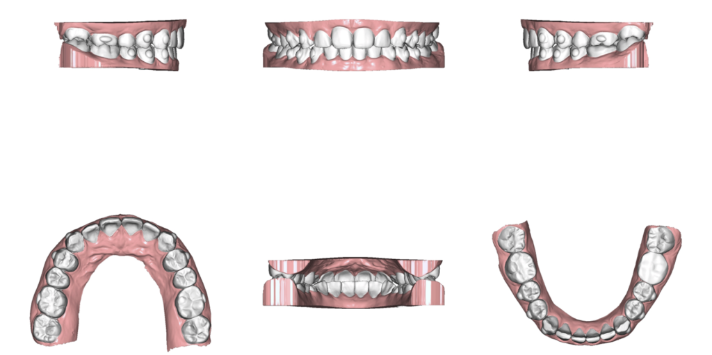 歯並びシミュレーション